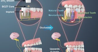 3D-Printed Piezoelectric Tooth Implant Restores Chewing Sensation in 90% of Trial Patients