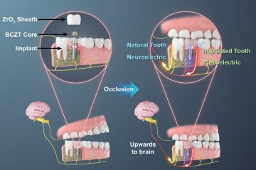 3D-Printed Piezoelectric Tooth Implant Restores Chewing Sensation in 90% of Trial Patients